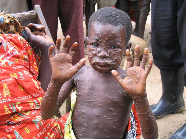 Monkey Pox – Panic In South-East Nigeria as Military immunize School Children