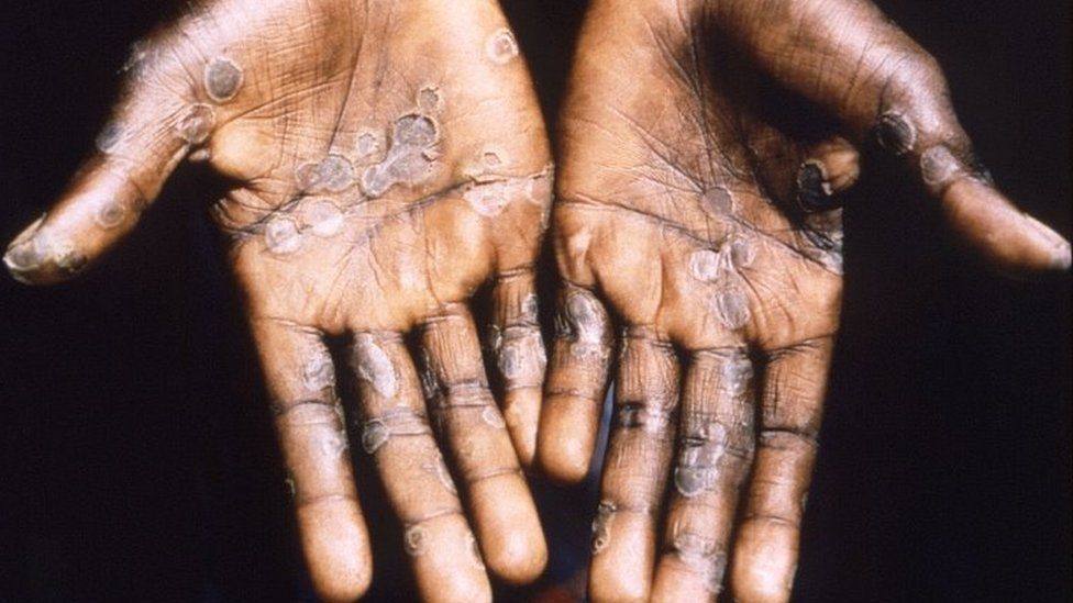 More worries as Monkeypox spreads, says WHO